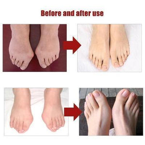 Adjustable Bunion Corrector-Perfect Pain Relief